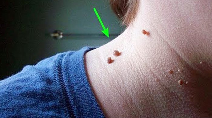 আঁচিল (Wart) দূর করার উপায়? আঁচিল কেন হয়!